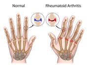 Herbs and Rheumatoid Arthritis