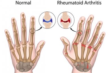 Herbs and Rheumatoid Arthritis